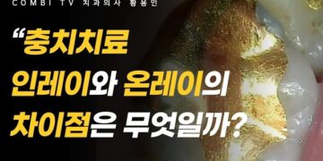 [대한건강의료신문]-충치치료-방법-4가지-중-온레이와-인레이의-차이