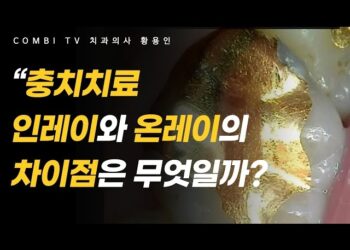 [대한건강의료신문]-충치치료-방법-4가지-중-온레이와-인레이의-차이