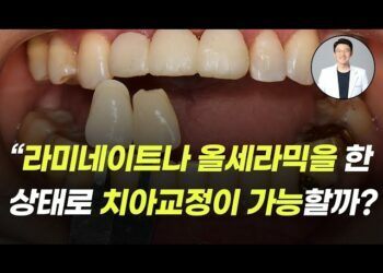 [대한건강의료신문]-라미네이트나-올세라믹을-한-상태에서-치아교정이-가능할까?