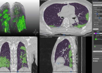[대한건강의료신문]-ai-폐렴분석-의료기기-‘메딥-뉴모비드’